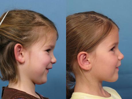 photo gallery ear repositioning ruth consent for treatment form