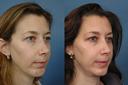 Non Surgical 11