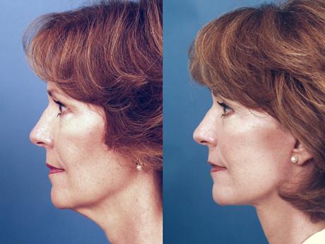Facelift1