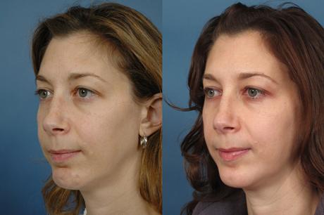 Non Surgical 10