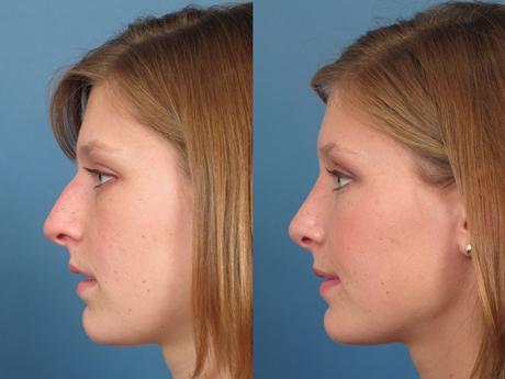 Nose1