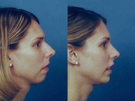mentoplasty1