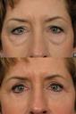 eye2