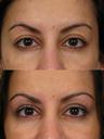 Non Surgical 3