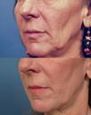Non Surgical 5