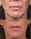 Non Surgical 6