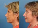 Non Surgical 13