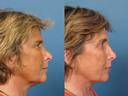 Non Surgical 14