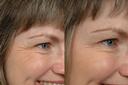 Non Surgical 17