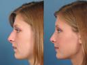 Nose1