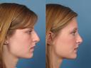 Nose3
