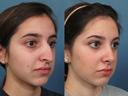 Nose6