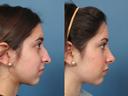 Nose7