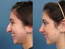 Nose10