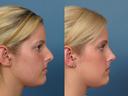 Nose17