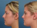Nose18