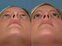 Nose20