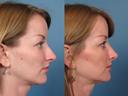 Nose22
