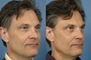 Rhinoplasty Pick2