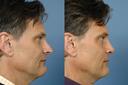 Rhinoplasty Pick3