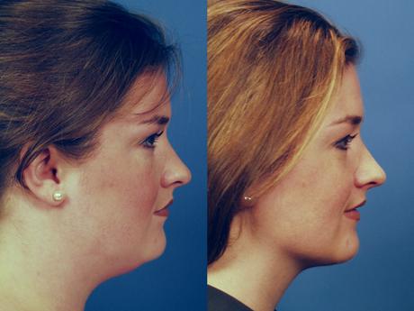 Neck 3