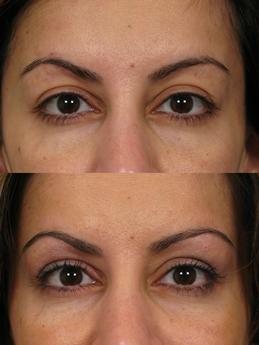 Non Surgical 3