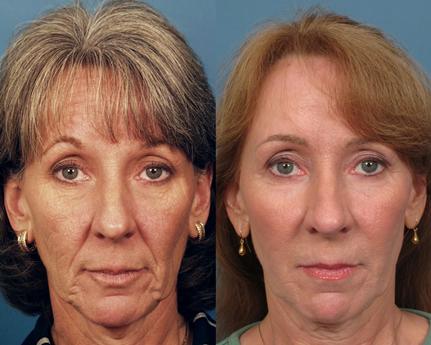 Non Surgical 4