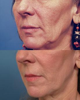 Non Surgical 5