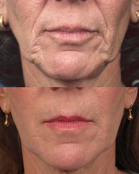 Non Surgical 6