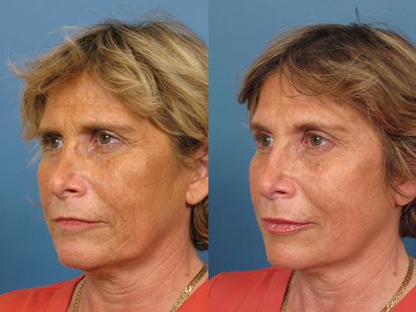 Non Surgical 12