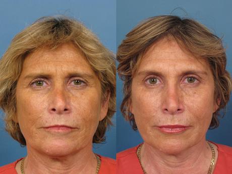 Non Surgical 15