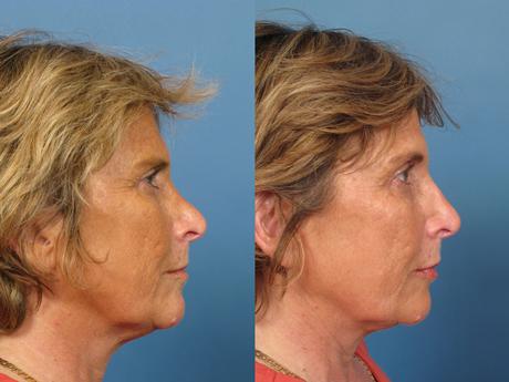 Non Surgical 14