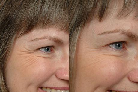 Non Surgical 17