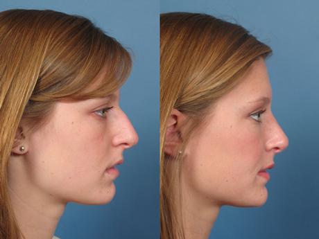 Nose3