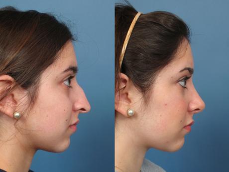 Nose7