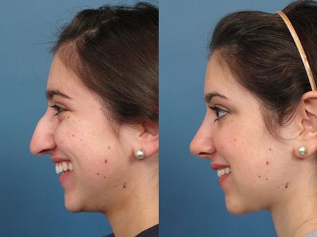 Nose10