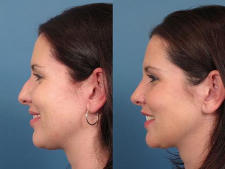 Nose13