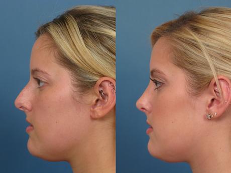 Nose18
