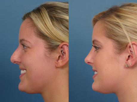 Nose19