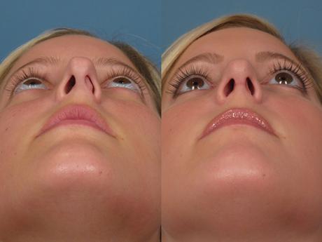 Nose20