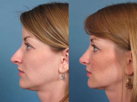 Nose24