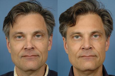 Rhinoplasty Pick