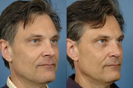 Rhinoplasty Pick2
