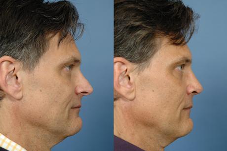 Rhinoplasty Pick3